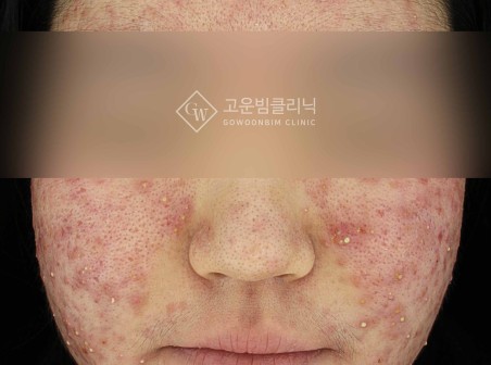 반복되는 성인 여드름, 단순 관리가 아닌 '뿌리'를 치료해야 합니다